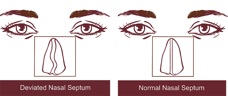 An image of a deviated and normal nasal septum