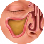 A graphic that depicts what happens to the sinus before balloon sinuplasty