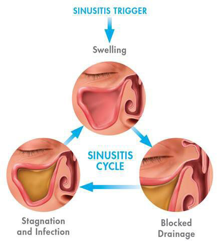 A diagram shows what triggers sinusitis