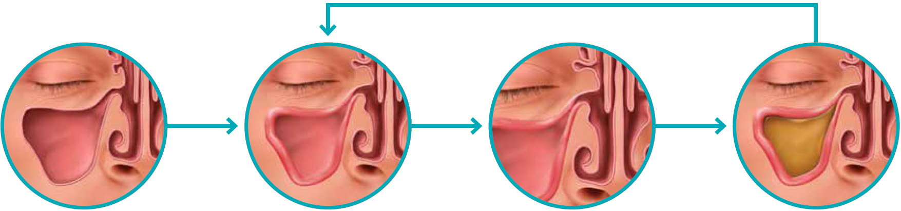 A graphic that depicts what sinusitis is